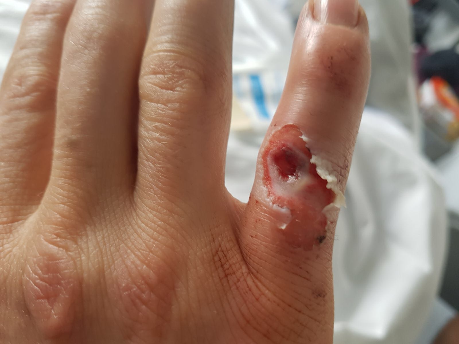 SBK 1000 – Schock für Kawasaki: Mathieu Gines verletzt